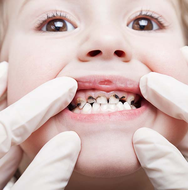 Tooth decay Treatments Gympie